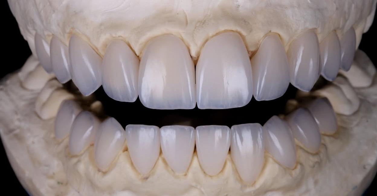 Wax mock-up style aesthetic case showing veneered teeth on mounted dental models