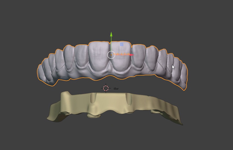 CAD-CAM diagram of a treated molar prepared for a crownlay restoration