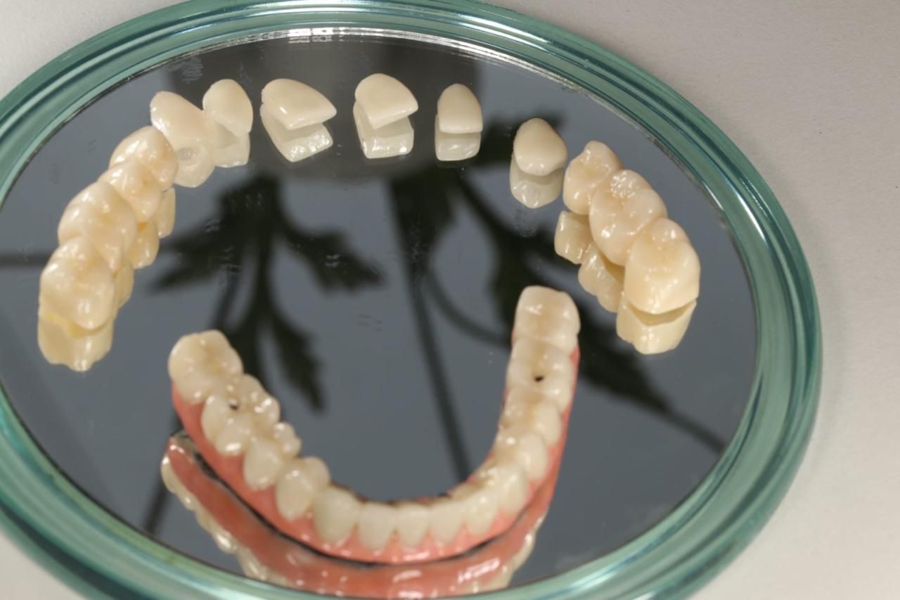 Single zirconia anterior crown displayed on a dental model