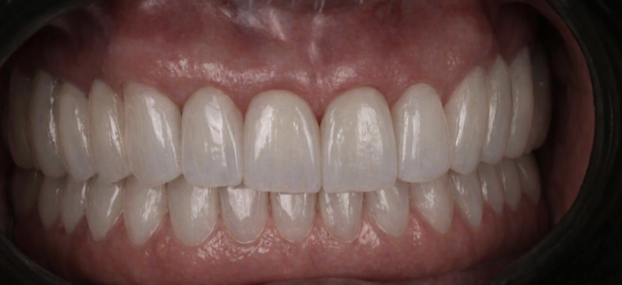 Full-arch implant overdenture with four implant attachment housings